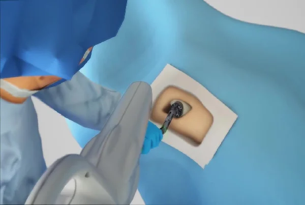 Hip Replacement