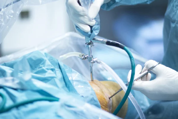 Arthroscopic Surgery